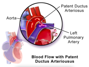 What does PDA stand for in medical terms